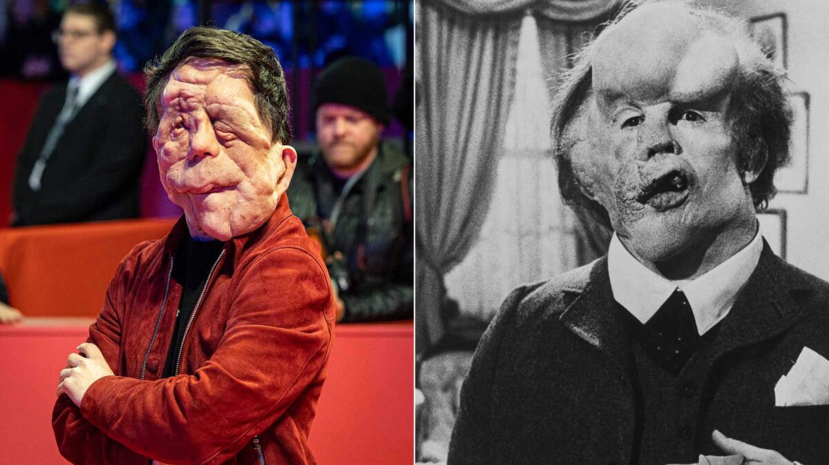 The Elefant Man: Adam Pearson protagonista del nuovo adattamento